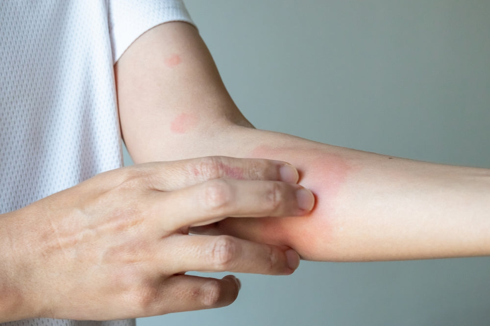 Natural Alternatives to Steroids for Eczema & Psoriasis | Risks of Topical Steroid Withdrawal (TSW)